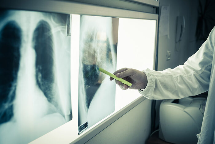 Arzt deutet mit einem Stift auf die Röntgenaufnahme einer von Tuberkulose befallenen Lunge