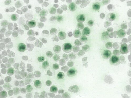 Bone marrow smear of an AML patient: The new software detects a specific gene mutation based on the external cell characteristics (dark green coloration).